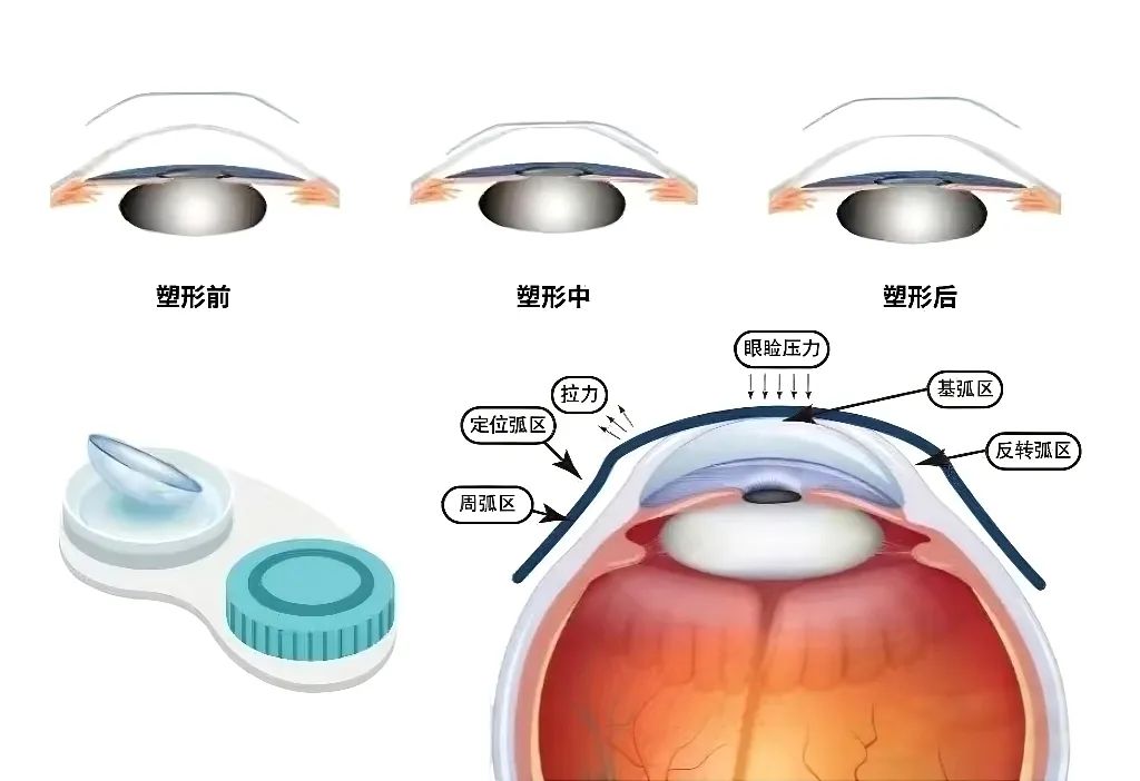 角膜塑形镜.jpg
