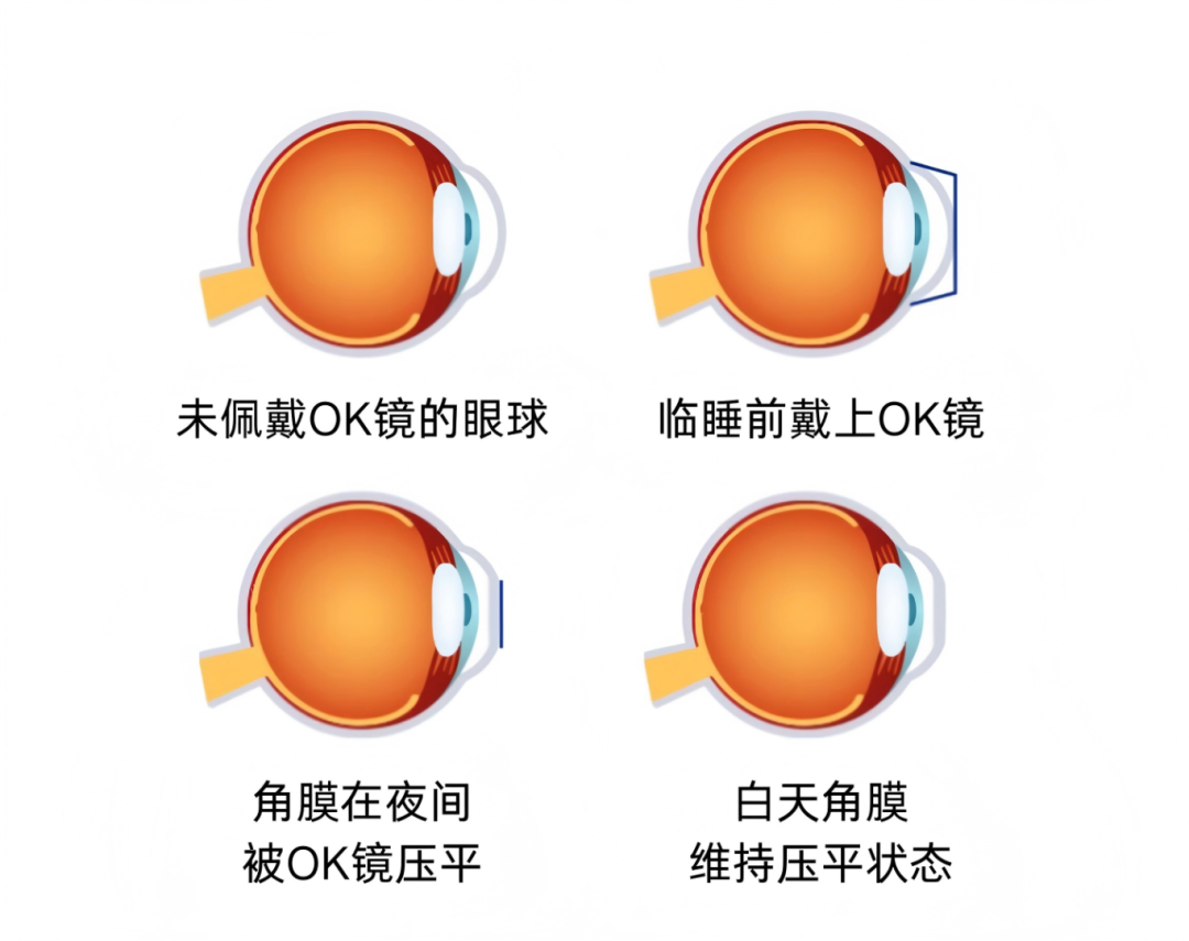 未佩戴OK镜的眼球(1).png