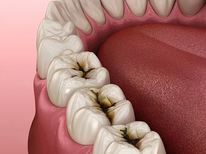 龋齿.png 龋齿.png